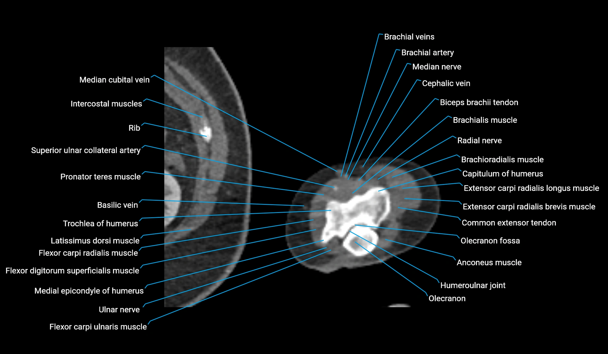 CT upper arm axial  cross sectional anatomy labelled radiology image -00390.webp